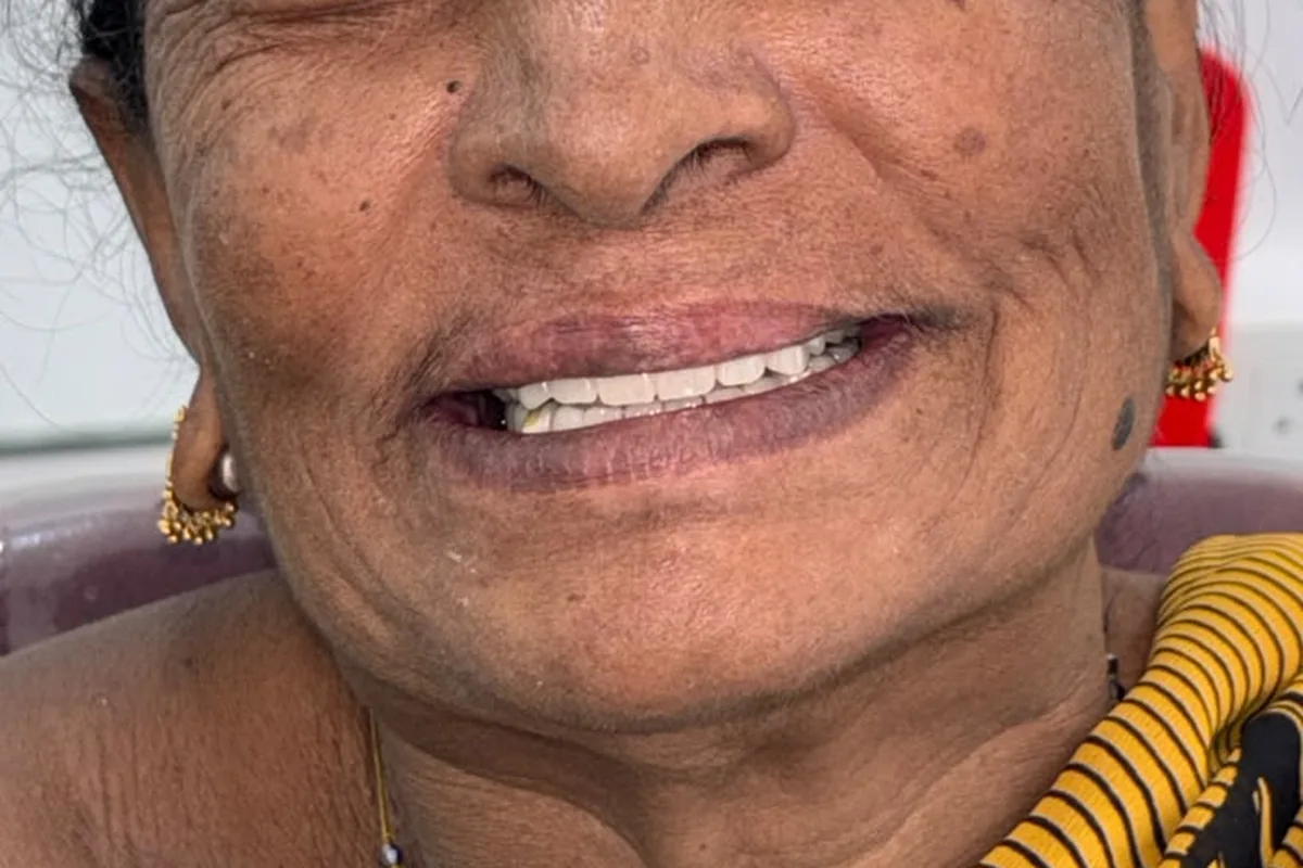 Dental Implants case 1, after treatment, at SR Multispeciality Dental Clinic