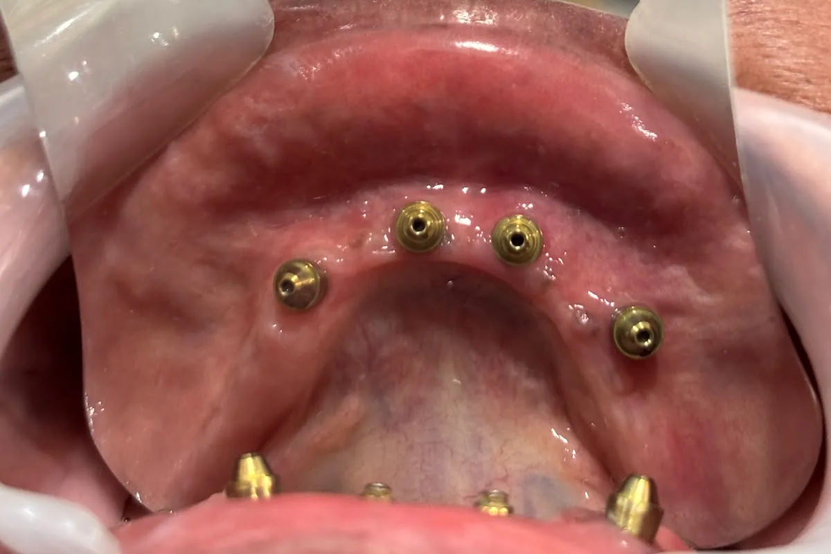 Dental Implants case 1, before treatment, at SR Multispeciality Dental Clinic