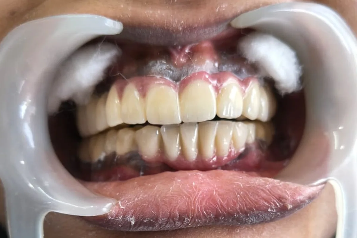 Full Mouth Rehabilitation case 1, after treatment, at SR Multispeciality Dental Clinic