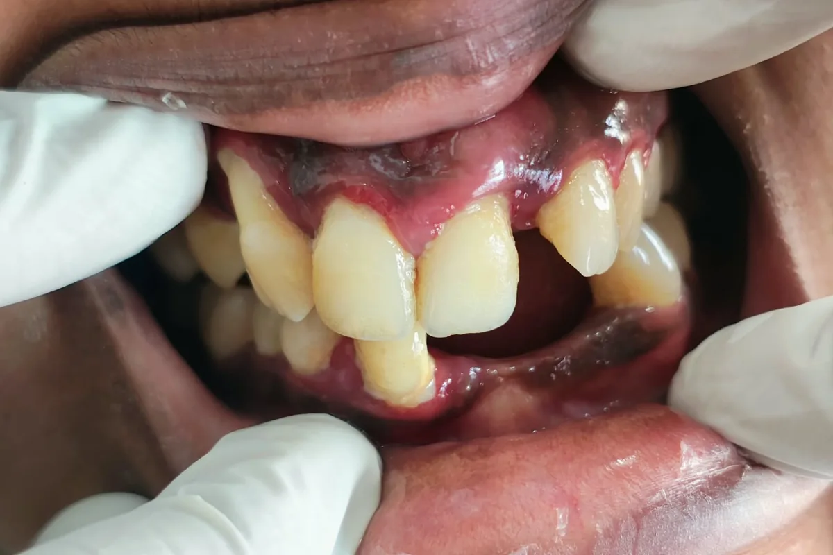 Full Mouth Rehabilitation case 1, before treatment, at SR Multispeciality Dental Clinic
