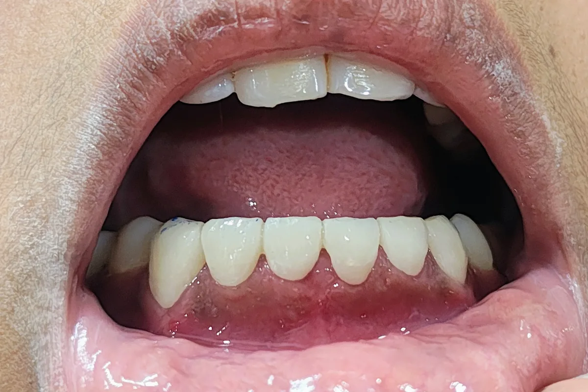 Root Canal Treatment case 1, after treatment, at SR Multispeciality Dental Clinic