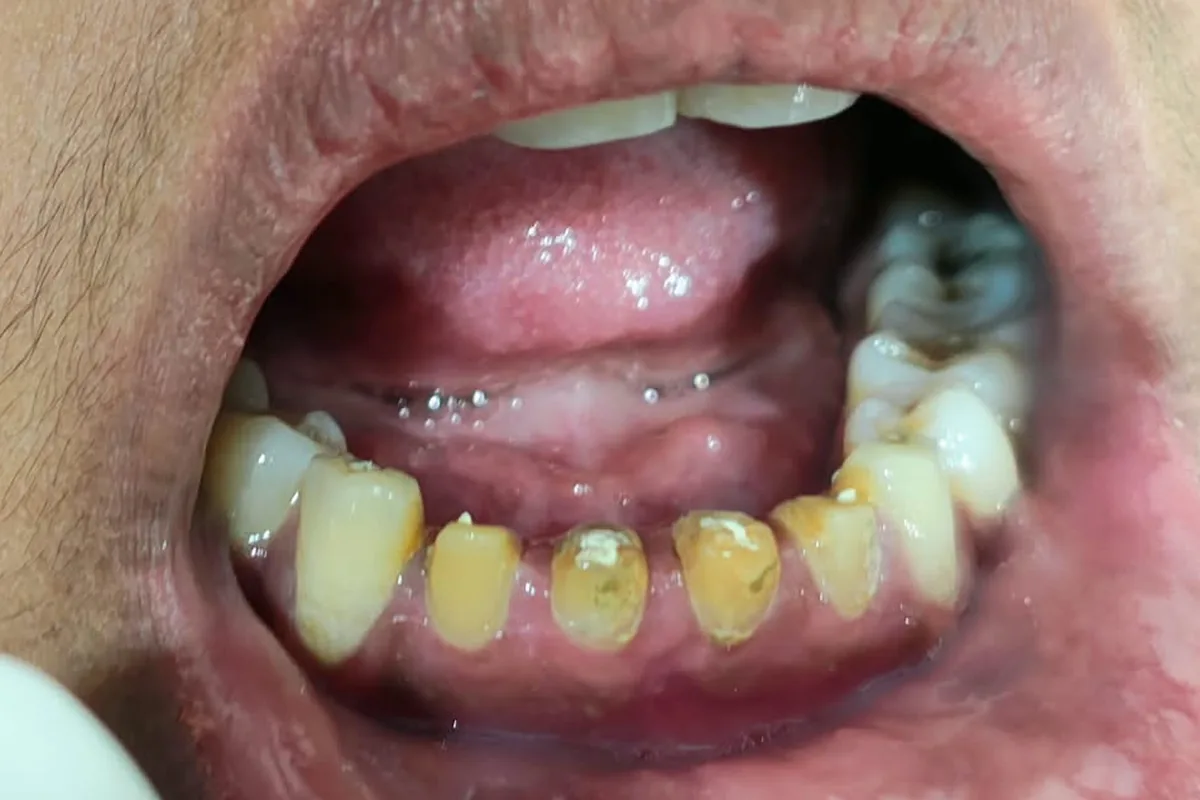 Root Canal Treatment case 1, before treatment, at SR Multispeciality Dental Clinic