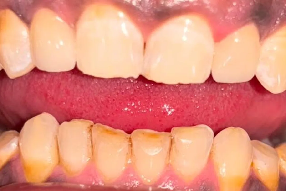 Veneers & Laminates case 1, after treatment, at SR Multispeciality Dental Clinic