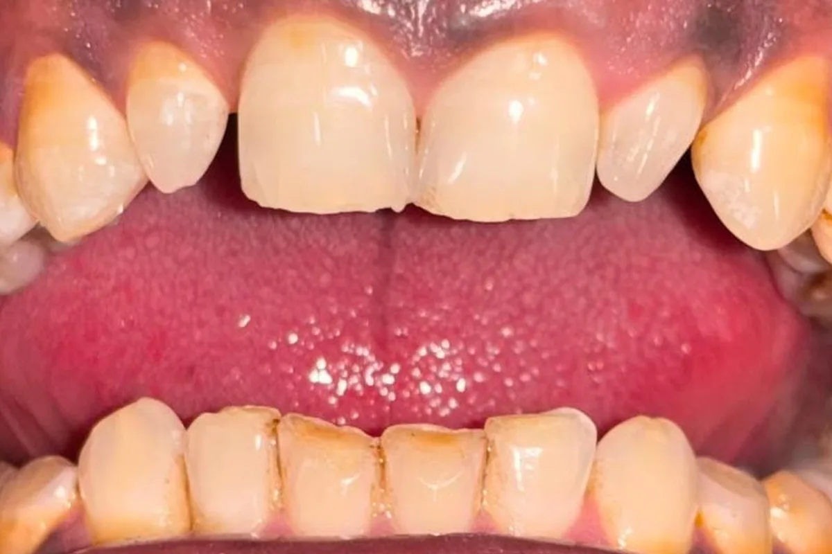 Veneers & Laminates case 1, before treatment, at SR Multispeciality Dental Clinic